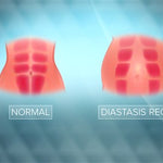 What Exactly is Diastasis Recti?